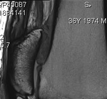 Quadriceps Tendinosis MRI